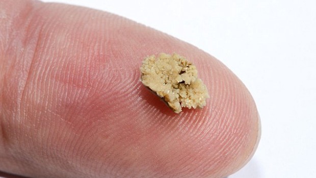 Препарат для лечения заболевания простаты поможет избавиться от камней в почках