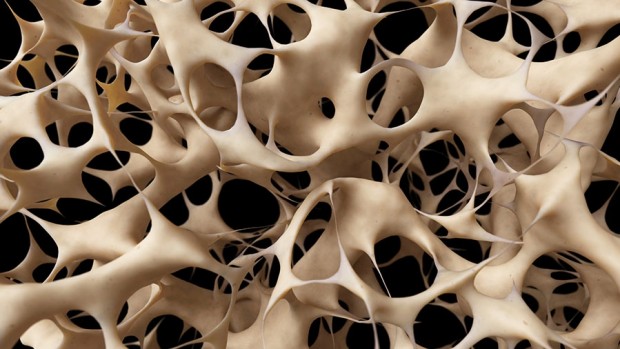 Снижение плотности костной ткани является одним из индикаторов болезни Альцгеймера