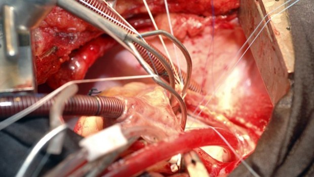 Медики использовали стволовые клетки для регенерации сердца
