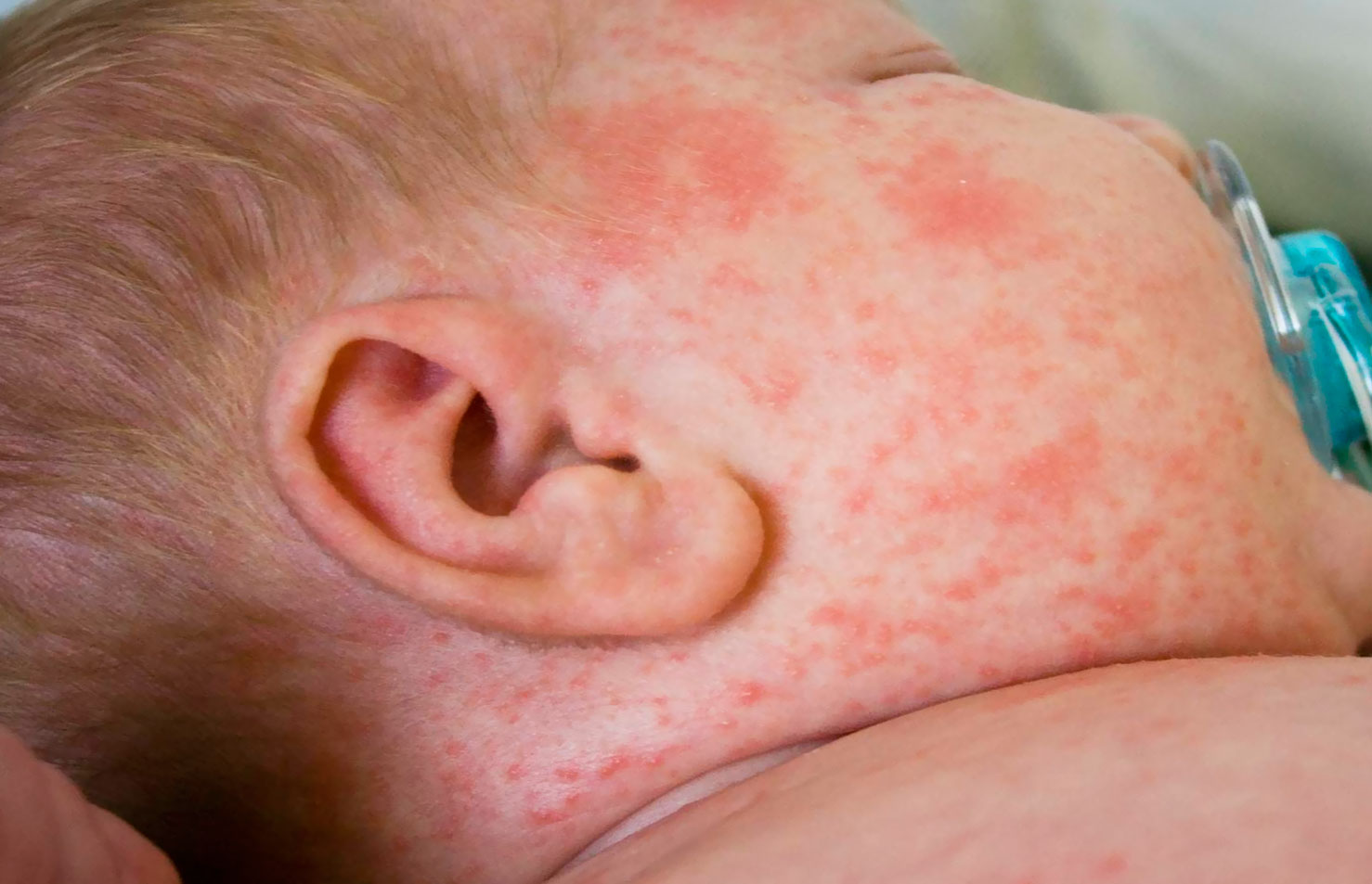 Причины пеленочного дерматита у новорожденных