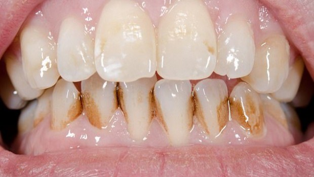 Использование наркотиков разрушает зубы