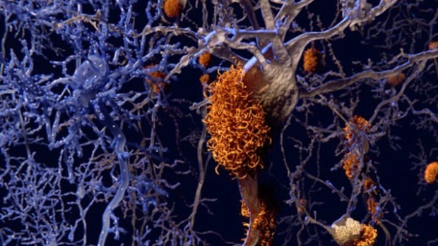 Ученые совершили прорыв в лечении болезни Альцгеймера