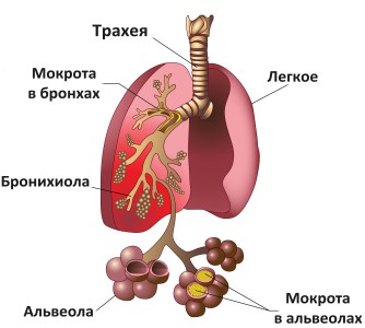 Пневмония — симптомы, признаки и причины