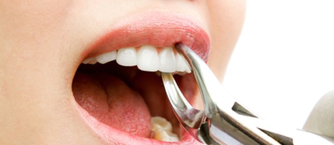 Как остановить кровь после удаления зуба?