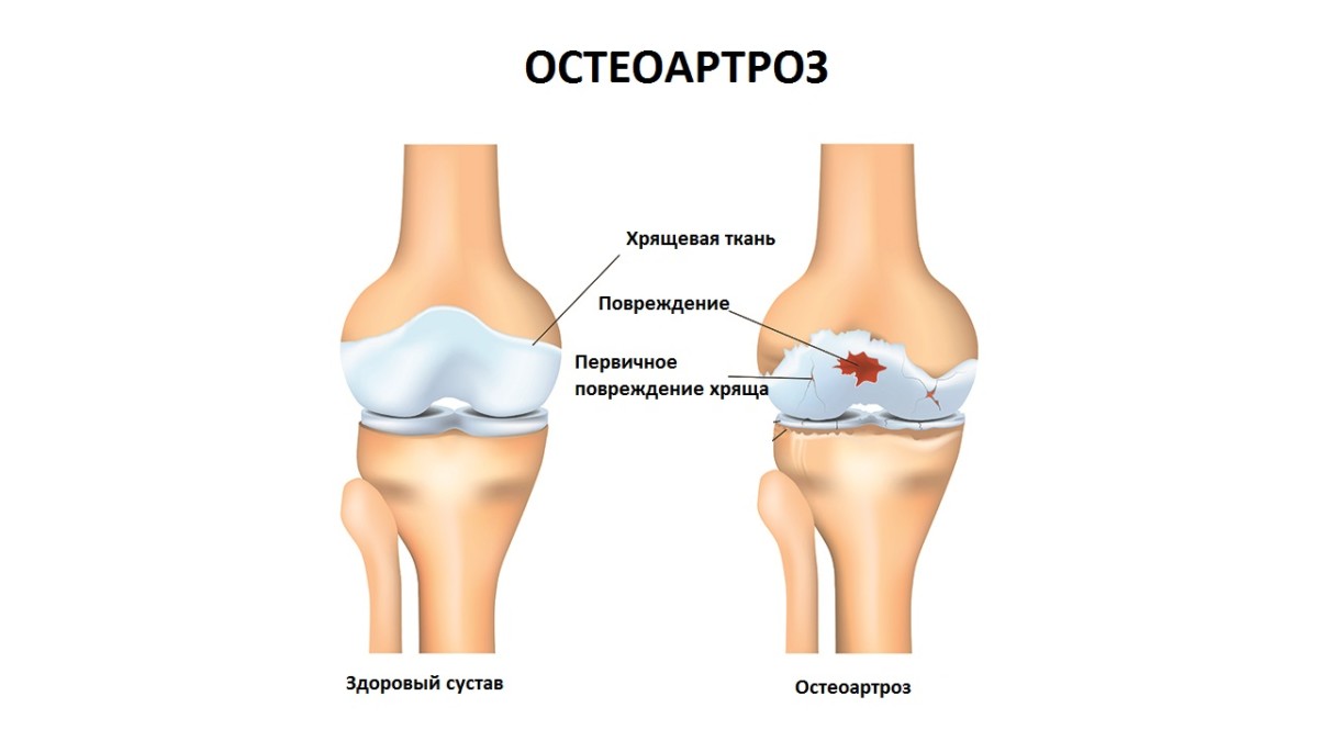 Остеоартрит — причины, симптомы и лечение