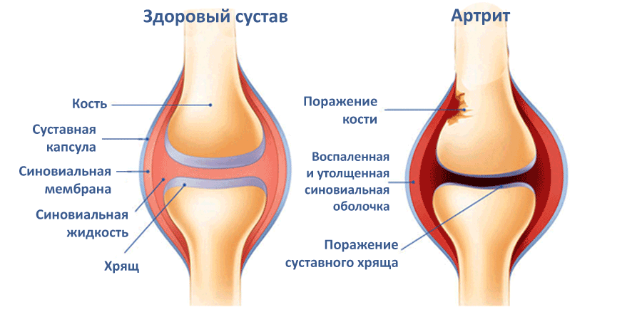 Артрит коленного сустава — симптомы и причины