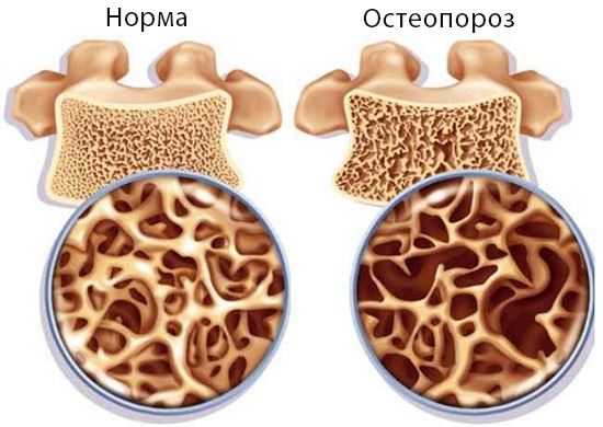 Остеопороз — основные симптомы