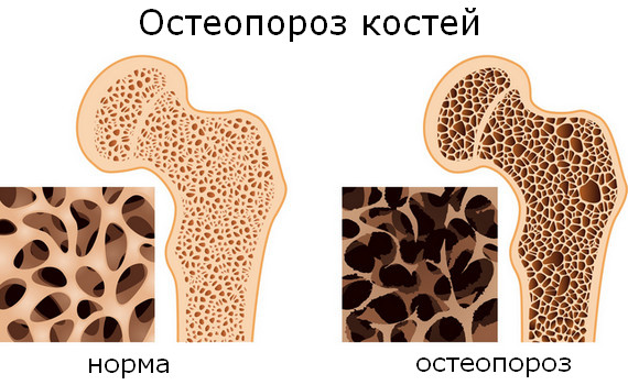 Остеопороз — основные симптомы