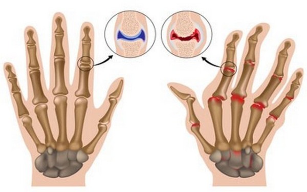 Артрит суставов и пальцев рук