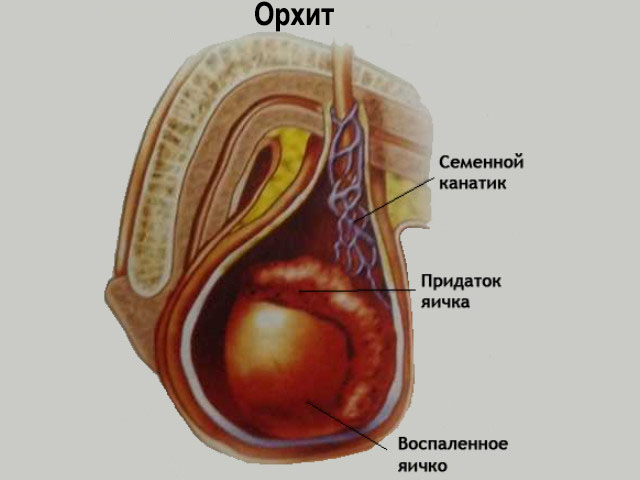Орхит — симптомы и лечение