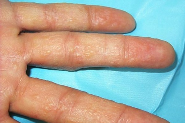 Дисгидротическая экзема на пальцах рук