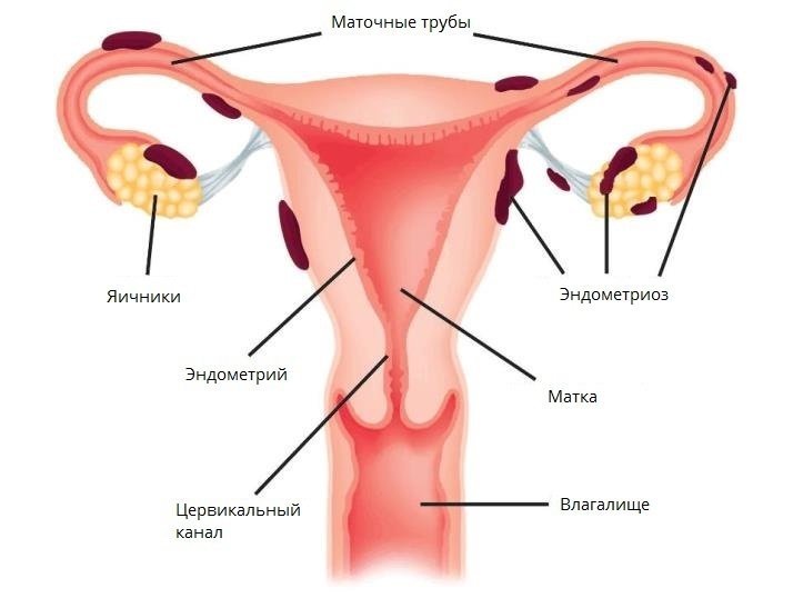 Эндометриоз матки – что это такое и как лечить?
