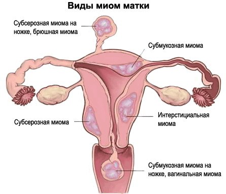 Эндометриоз, эндометрит и миома матки – в чем разница?
