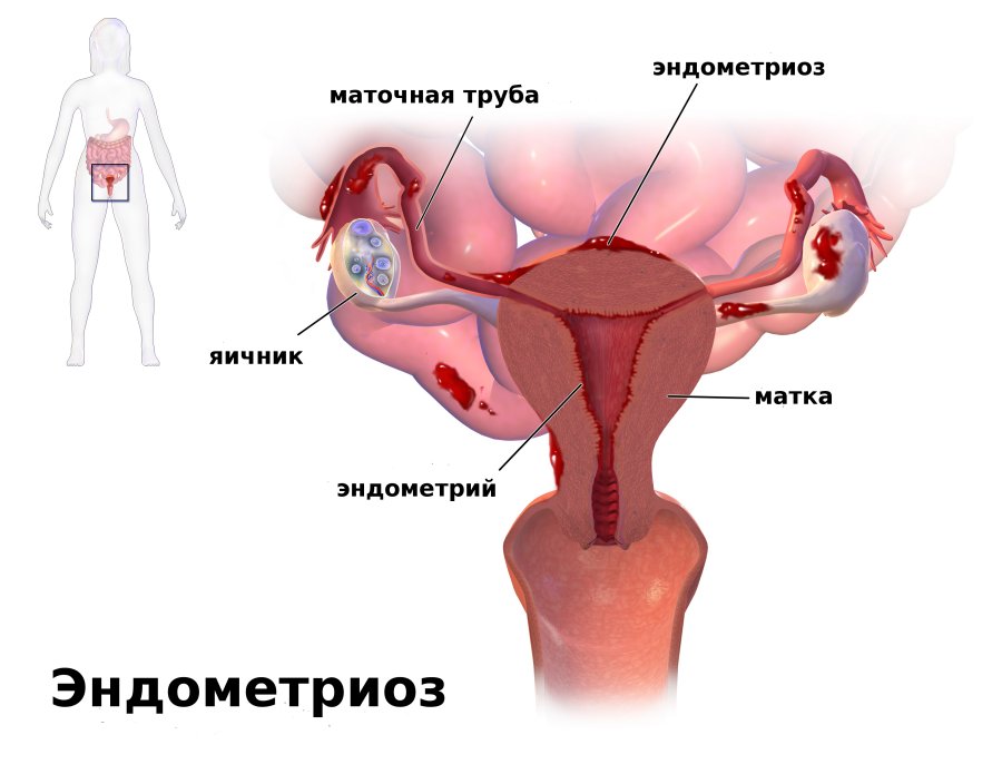 Эндометриоз, эндометрит и миома матки – в чем разница?