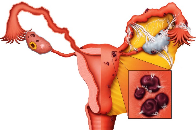 Лечение эндометриоза. Комбинированные оральные контрацептивы (КОК)