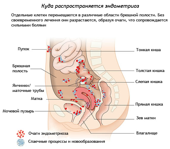 Эндометриоз кишечника
