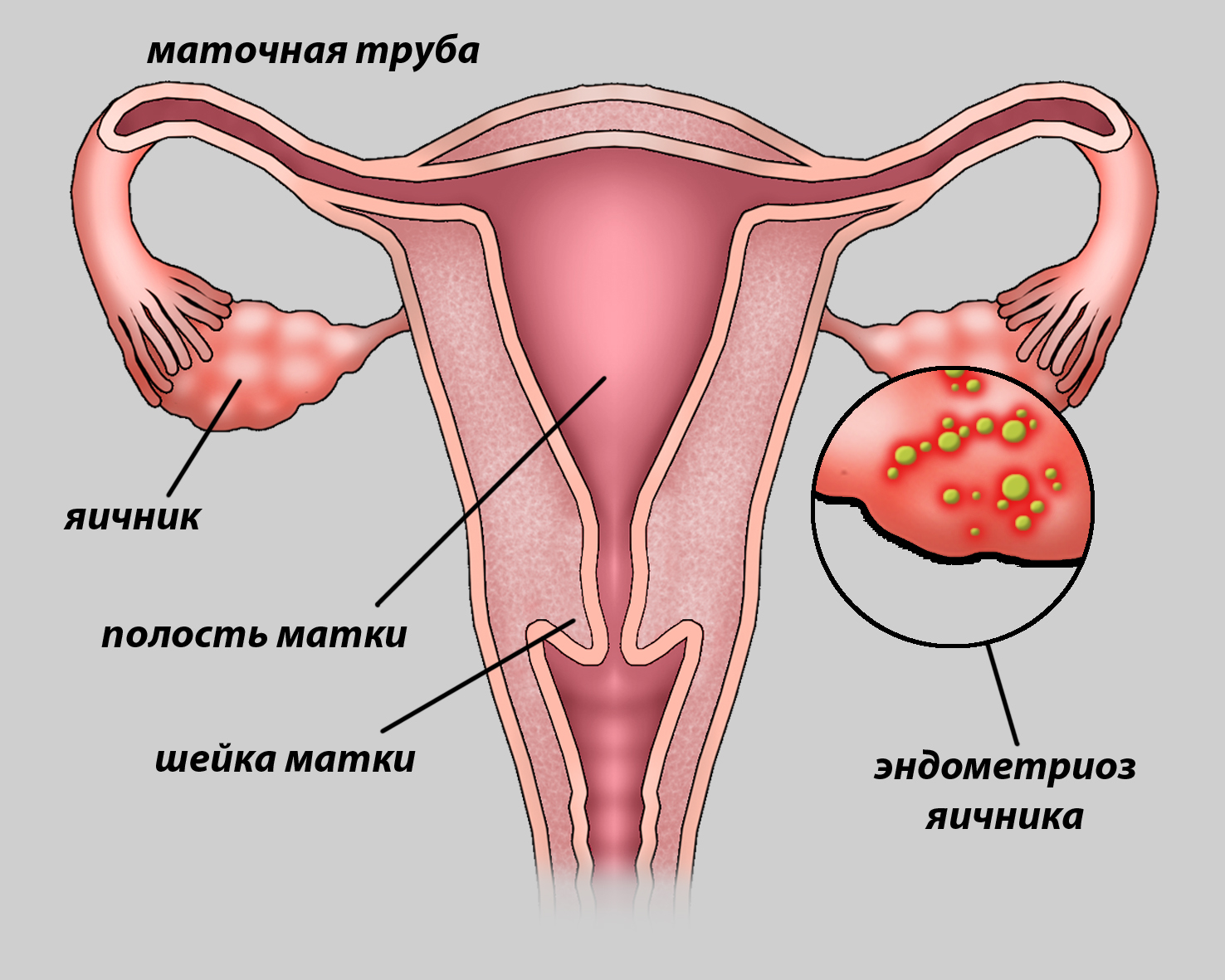Эндометриоз яичника