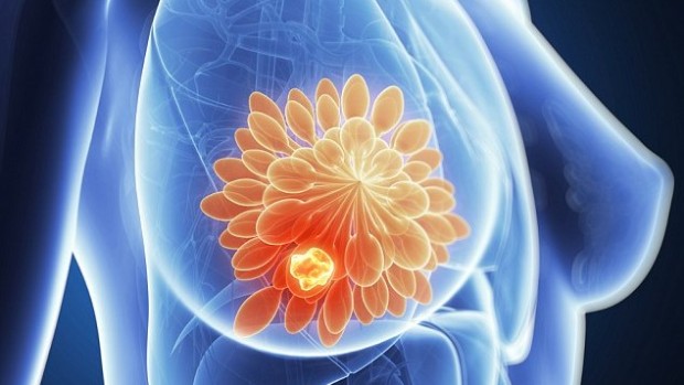 Ученые нашли способ сделать рак груди уязвимым к химиотерапии
