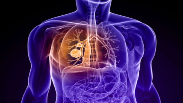 Ученые выяснили, как предотвратить распространение рака легких