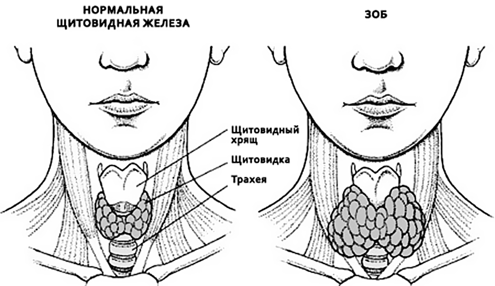 Диагностика зоба щитовидной железы