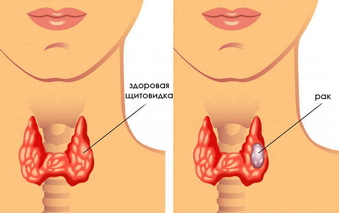 Причины, симптомы и лечение узлов щитовидной железы. Чем они опасны?