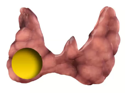 Причины узлов щитовидной железы