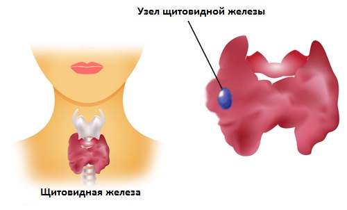 Лечение узлов щитовидной железы