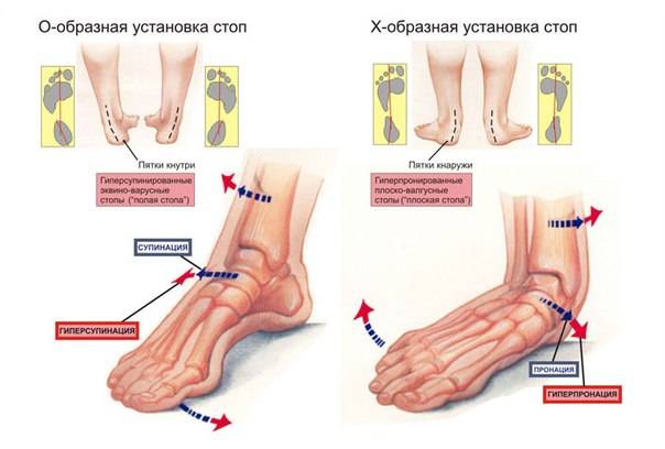 Причины и симптомы шишек на ногах