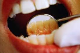 Почему темнеют зубы: 12 основных причин