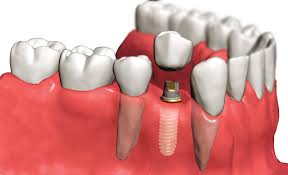 Основные разновидности зубных имплантов