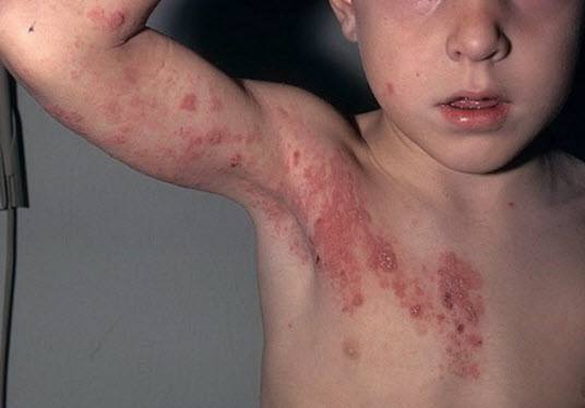 Симптомы и лечение цитомегаловируса у детей