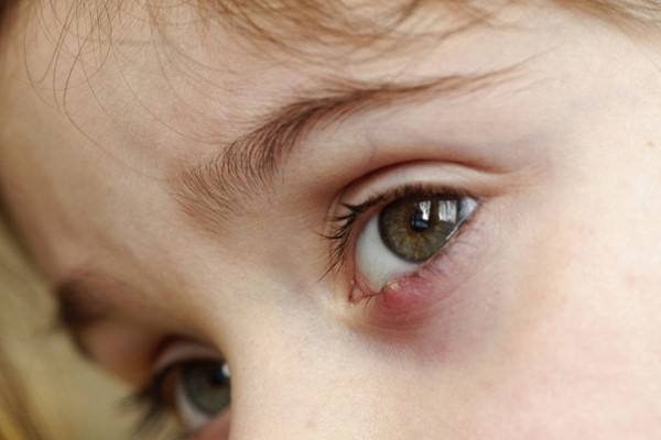 Халязион на глазу у детей (ребенка)