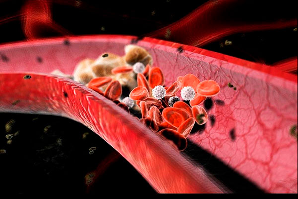 Причины свертывания крови, как избежать образования тромбов