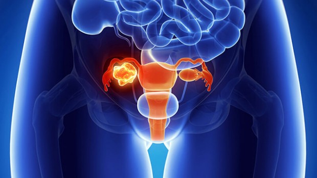 Специалисты рассказали о признаках, свидетельствующих о развитии рака яичников у женщин
